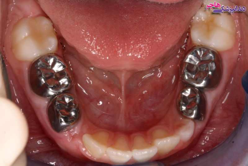 روکش استیل دندان معمولا به صورت موقت استفاده میشود